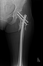 Broken interlocking screws proximal